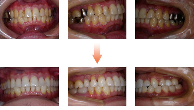 歯がボロボロの症例4