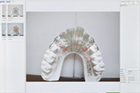 歯の移動量を計測