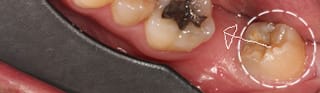 歯の移植・再植 (歯牙移植・保存)