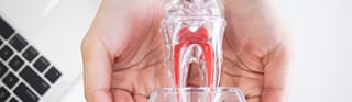 虫歯と根管治療