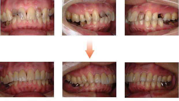 歯がボロボロの症例1