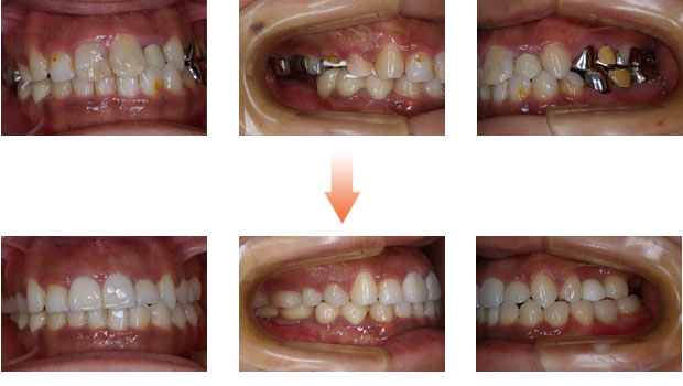 歯がボロボロの症例2