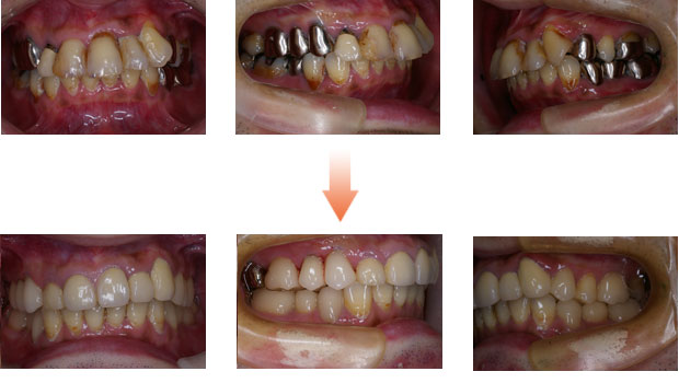 歯がボロボロの症例3