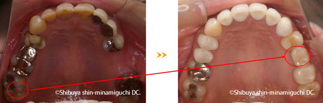 親知らず 奥歯を前に移動する治療 奥歯の部分矯正 渋谷新南口歯科