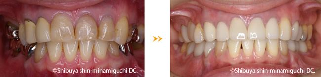 親知らず 奥歯を前に移動する治療 奥歯の部分矯正 渋谷新南口歯科
