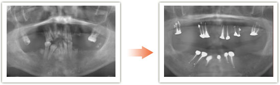 根面板の入れ歯の例