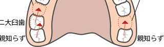 親知らず・奥歯を前に移動